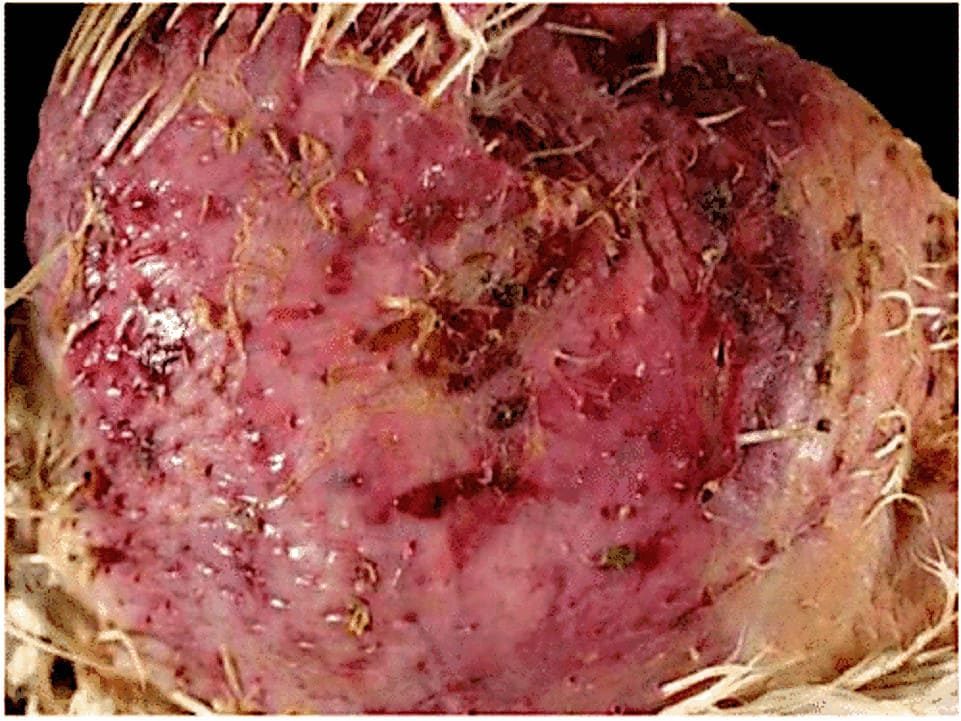 Dermatitis de cadera y dorso.