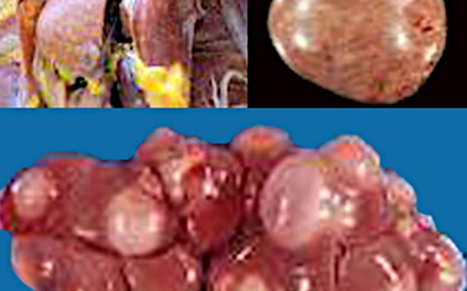 Leucosis linfoide, hígado, bazo, riñón.