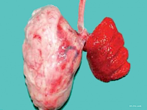 Neoplasia pulmonar. Marens