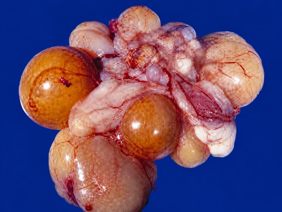 Óvulos flácidos, pálidos, causados por Salmonella paratyphi.