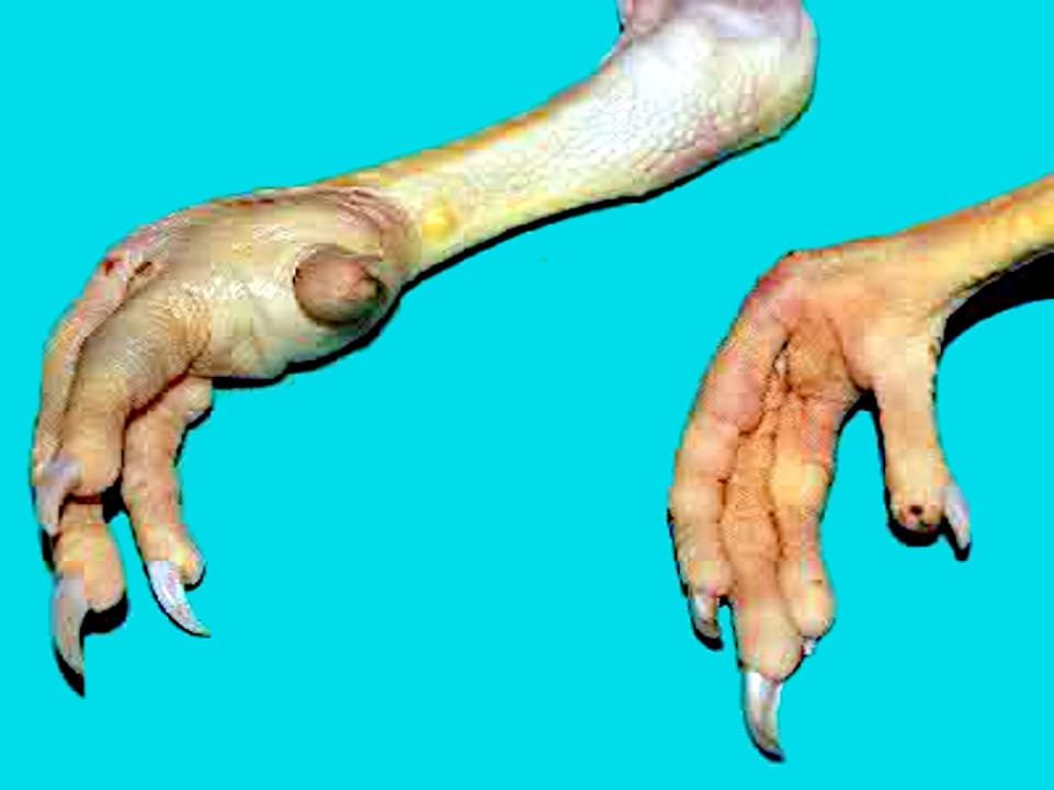 Gota articular y visceral